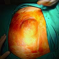 Tzeveleki Surgery Umbilical hernia 3