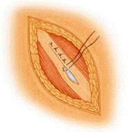 Tzeveleki Surgery hernias 3