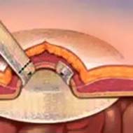 Tzeveleki Surgery hernias 4