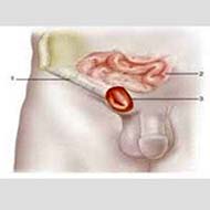 Tzeveleki Surgery hernias 5