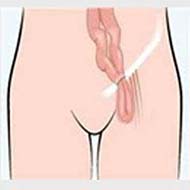 Tzeveleki Surgery hernias 6
