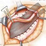 Tzeveleki Surgery hernias treatment 2