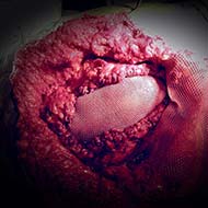Tzeveleki Surgery hernias 7