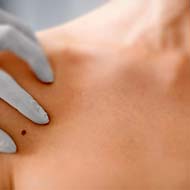 Tzeveleki Surgery Skin diseases moles 1