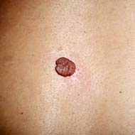 Tzeveleki Surgery Skin diseases moles 2