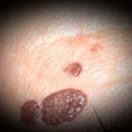 Tzeveleki Surgery Skin diseases moles 3