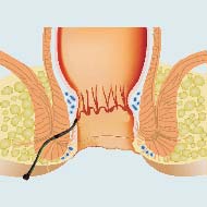 Tzeveleki Surgery Perianal fistulas 1