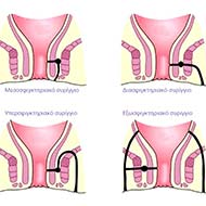 Tzeveleki Surgery Perianal fistulas 2