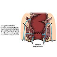 Tzeveleki Surgery Perianal fistulas 3