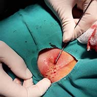 Tzeveleki Surgery Perianal fistulas Diagnosis 2