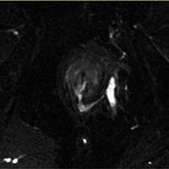 Tzeveleki Surgery Perianal fistulas Diagnosis 3