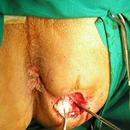 Tzeveleki Surgery Perianal fistulas Treatment 1