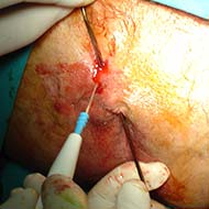 Tzeveleki Surgery Perianal fistulas Treatment 2