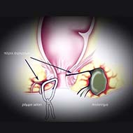 Tzeveleki Surgery Perianal fistulas Treatment 3