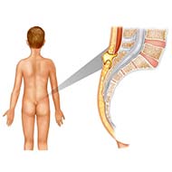 Tzeveleki Surgery Pilonidal Disease1