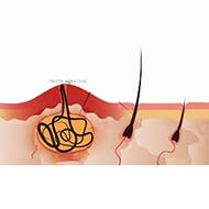 Tzeveleki Surgery Pilonidal Disease 2