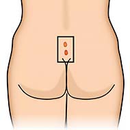 Tzeveleki Surgery Pilonidal Disease 3