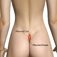 Tzeveleki Surgery syringotomy method 1