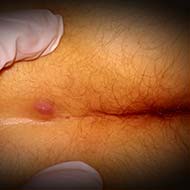 Tzeveleki Surgery Pilonidal Disease 5