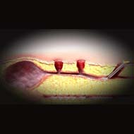 Tzeveleki Surgery Laser bladder resection method (FiLaC) 1