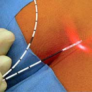 Tzeveleki Surgery Laser bladder resection method (FiLaC) 2