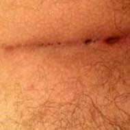 Tzeveleki Surgery syringotomy method 2